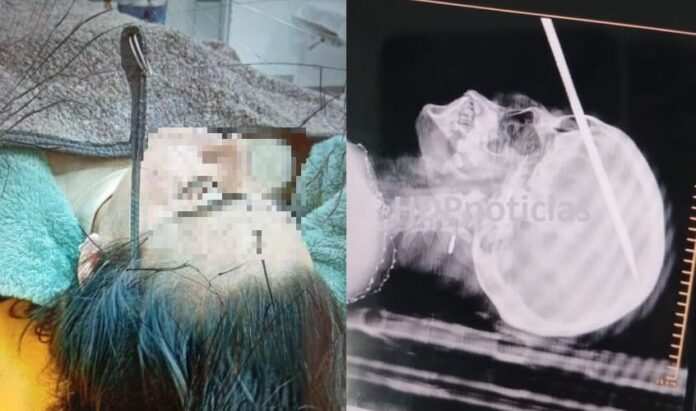 Un fierro en la cabeza